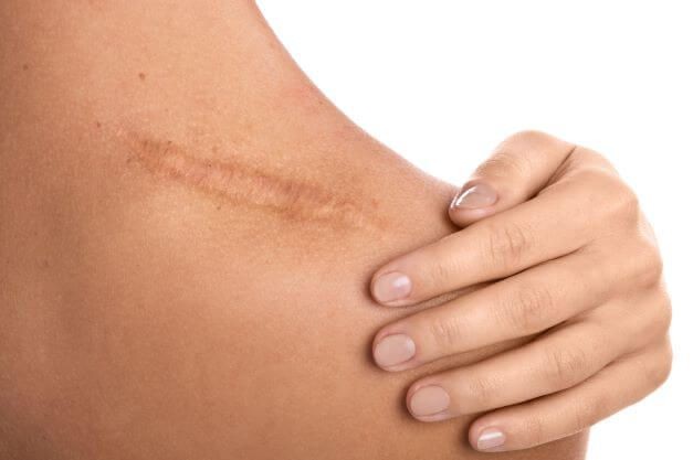 Terapia funcional em cicatrizes